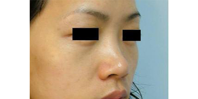 自體脂肪隆鼻術(shù)前