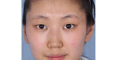 自體脂肪豐鼻基底術(shù)前