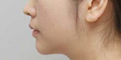 膨體墊下巴術后