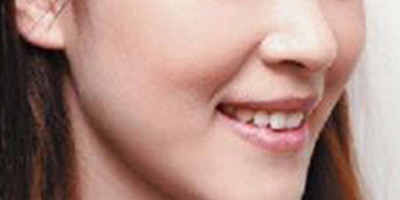 自體脂肪豐蘋果肌術(shù)后