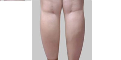 動(dòng)氧瘦小腿術(shù)前