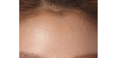 自體脂肪豐額頭術(shù)后