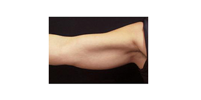 冷凍溶脂瘦手臂術(shù)前