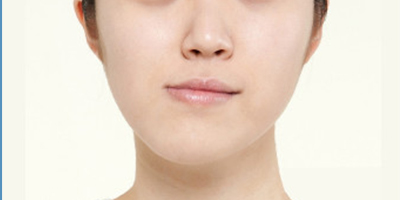 面部不對(duì)稱(chēng)矯正術(shù)前