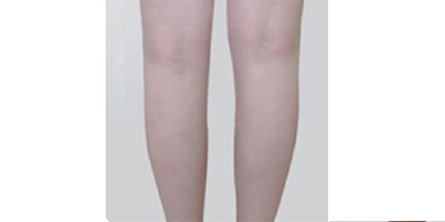 隔空溶脂瘦小腿術后