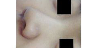 手術(shù)延長(zhǎng)鼻小柱術(shù)前