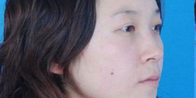 曼特波隆鼻術前