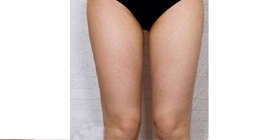 超聲溶脂瘦大腿術(shù)后