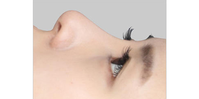 超體隆鼻術(shù)前