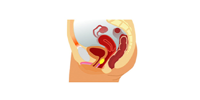 G點注射術(shù)后