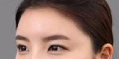 玻尿酸豐額頭術(shù)后