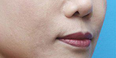 玻尿酸去法令紋術(shù)后