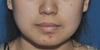 注射瘦臉術(shù)前