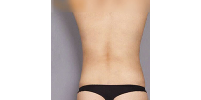 動(dòng)氧瘦背部術(shù)后