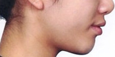 自體脂肪墊下巴術(shù)后