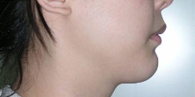 上顎前突/天包地術(shù)后