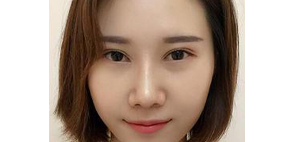 鼻中隔軟骨隆鼻術后