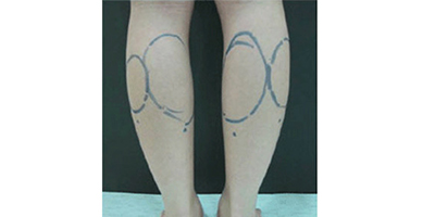 小腿吸脂術前