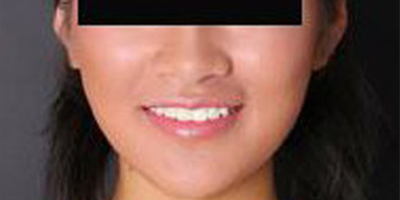 取頰脂墊瘦臉術后