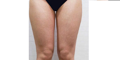 動氧瘦大腿術前