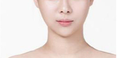 V-LINE瓜子臉手術(shù)術(shù)后