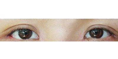 外眼角修復(fù)術(shù)后