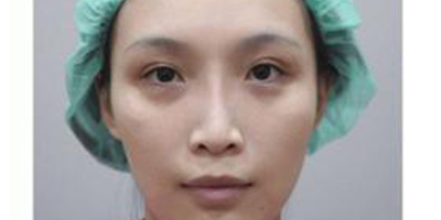 自體真皮隆鼻術(shù)前