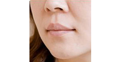 玻尿酸豐唇術(shù)前