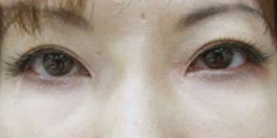 眼袋修復(fù)術(shù)后