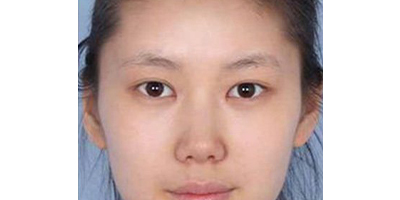 自體脂肪豐鼻基底術(shù)后