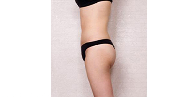 冷凍溶脂瘦大腿術(shù)后