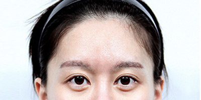 假體豐太陽穴術前