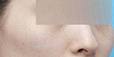 顴弓降低術(shù)前