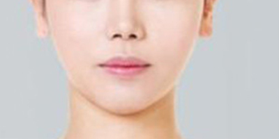 下頜角整形術(shù)后