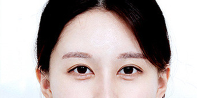 假體豐太陽穴術后