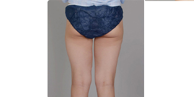 動(dòng)氧瘦臀部術(shù)前