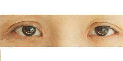 外眼角修復(fù)術(shù)前