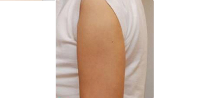 超聲溶脂瘦手臂術后