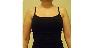 射頻溶脂瘦肩膀術(shù)前