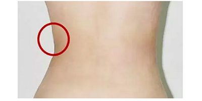 吸脂失敗修復(fù)術(shù)后