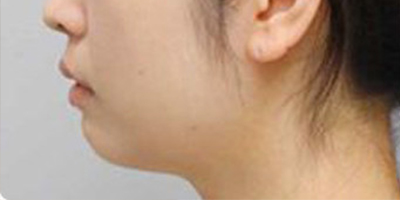 膨體墊下巴術前