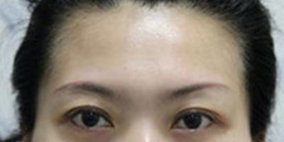 自體脂肪豐太陽(yáng)穴術(shù)前