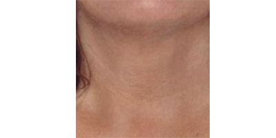 玻尿酸去頸紋術(shù)后