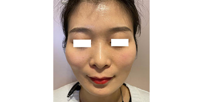 玻尿酸豐太陽穴術前