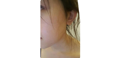 水楊酸煥膚術后