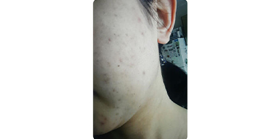 水楊酸煥膚術前