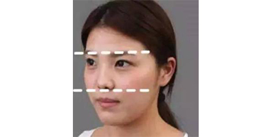 玻尿酸豐眉弓術(shù)前