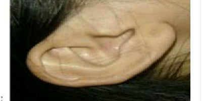 玻尿酸豐耳垂術(shù)前