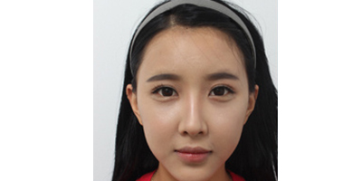 玻尿酸豐面頰術(shù)后