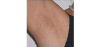 激光除腋臭術(shù)后